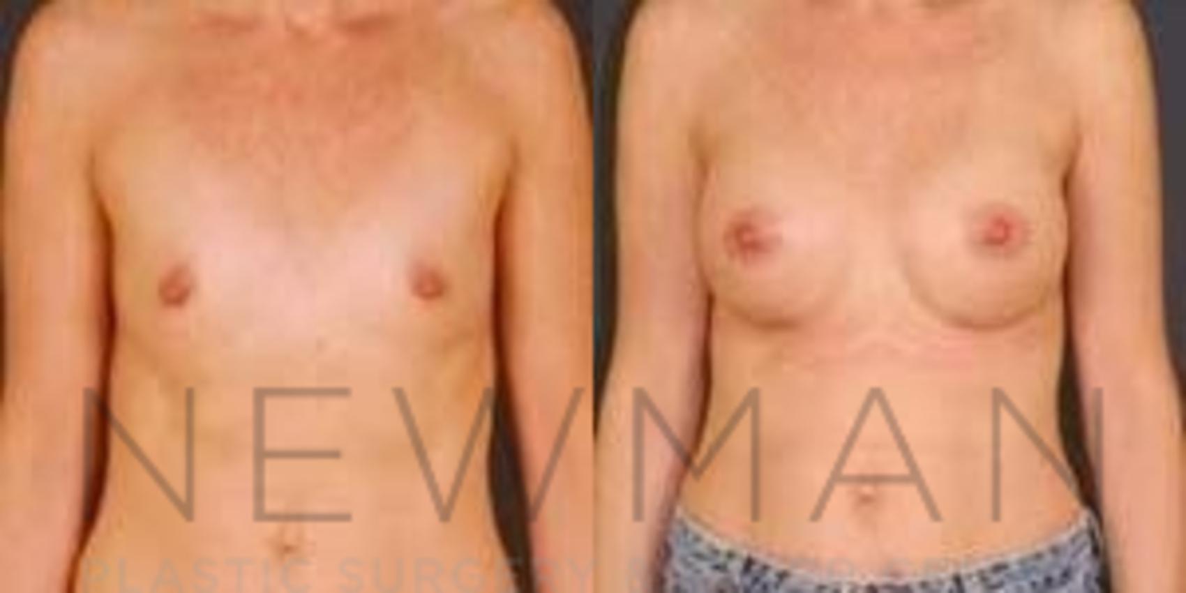 Before & After Breast Augmentation Case 107 Front View in Westchester County & Long Island, NY
