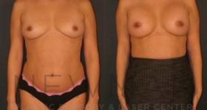 Before & After Breast Augmentation Case 108 Front View in Westchester County & Long Island, NY