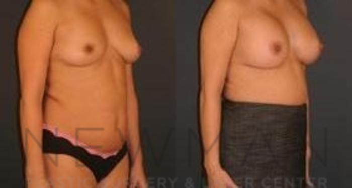 Before & After Breast Augmentation Case 108 Right Oblique View in Westchester County & Long Island, NY