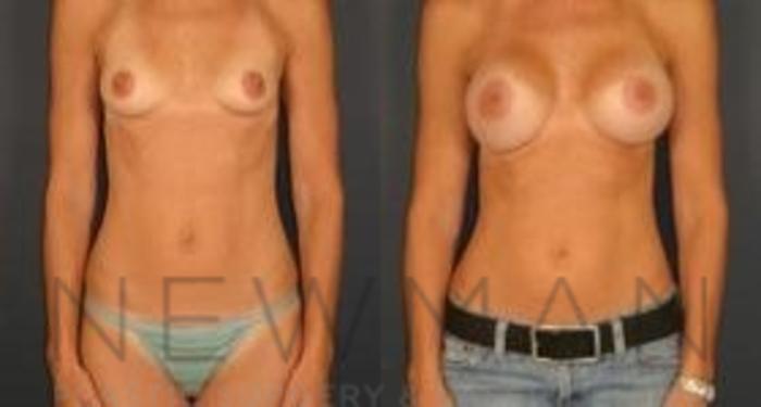 Before & After Breast Augmentation Case 109 Front View in Westchester County & Long Island, NY