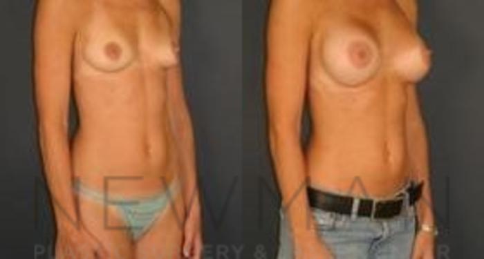 Before & After Breast Augmentation Case 109 Right Oblique View in Westchester County & Long Island, NY
