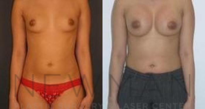 Before & After Breast Augmentation Case 110 Front View in Westchester County & Long Island, NY