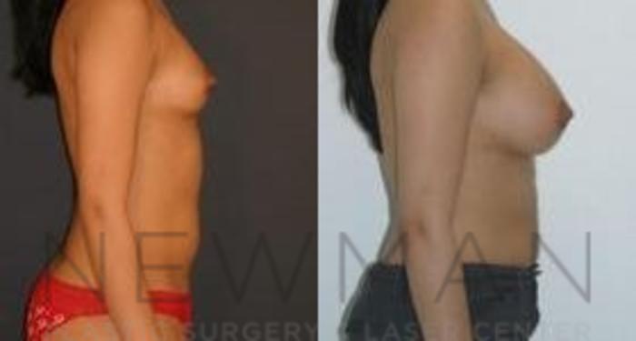 Before & After Breast Augmentation Case 110 Right Side View in Westchester County & Long Island, NY