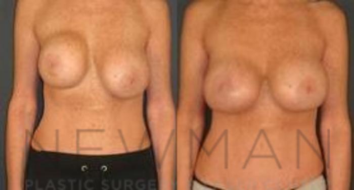 Before & After Breast Augmentation Case 111 Front View in Westchester County & Long Island, NY
