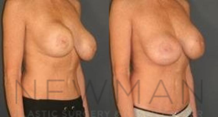 Before & After Breast Augmentation Case 111 Right Oblique View in Westchester County & Long Island, NY