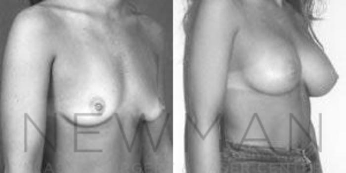 Before & After Breast Augmentation Case 112 Right Oblique View in Westchester County & Long Island, NY