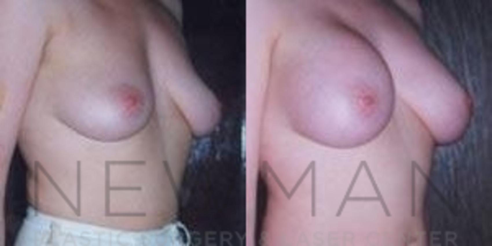 Before & After Breast Augmentation Case 113 Left Oblique View in Westchester County & Long Island, NY