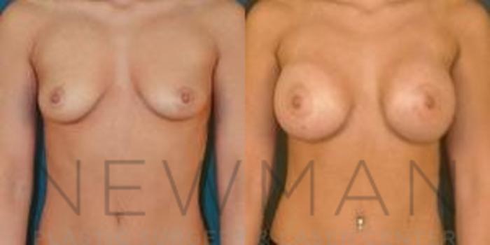 Before & After Breast Augmentation Case 115 Front View in Westchester County & Long Island, NY
