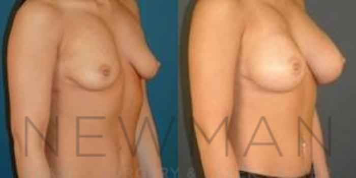 Before & After Breast Augmentation Case 115 Right Oblique View in Westchester County & Long Island, NY