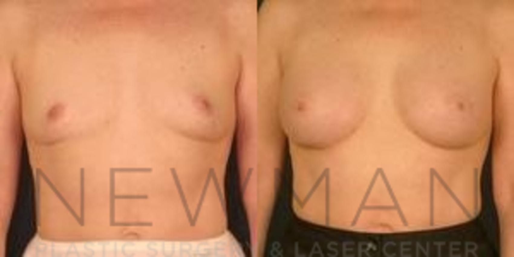 Before & After Breast Augmentation Case 116 Front View in Westchester County & Long Island, NY