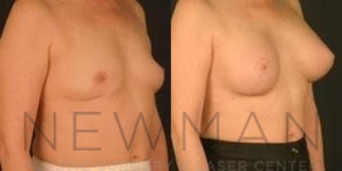 Before & After Breast Augmentation Case 116 Right Oblique View in Westchester County & Long Island, NY