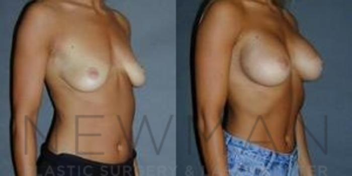 Before & After Breast Augmentation Case 117 Right Oblique View in Westchester County & Long Island, NY