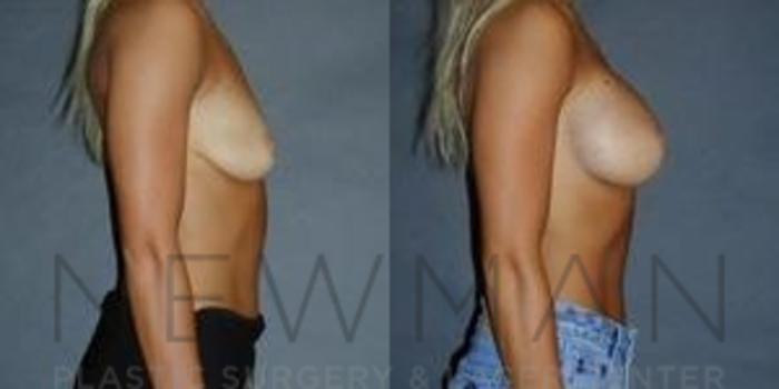 Before & After Breast Augmentation Case 117 Right Side View in Westchester County & Long Island, NY