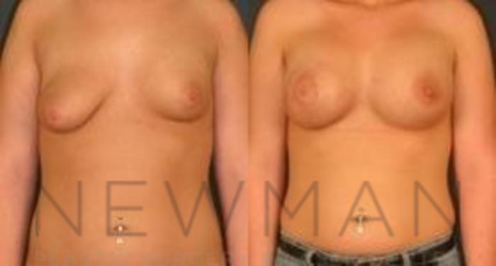 Before & After Breast Augmentation Case 118 Front View in Westchester County & Long Island, NY