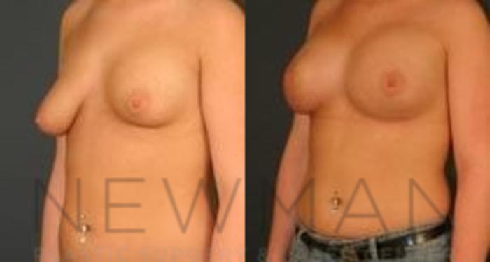 Before & After Breast Augmentation Case 118 Left Oblique View in Westchester County & Long Island, NY