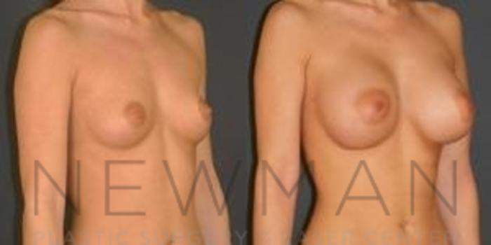 Before & After Breast Augmentation Case 119 Right Oblique View in Westchester County & Long Island, NY