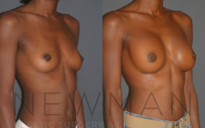 Before & After Breast Augmentation Case 12 Right Oblique View in Westchester County & Long Island, NY