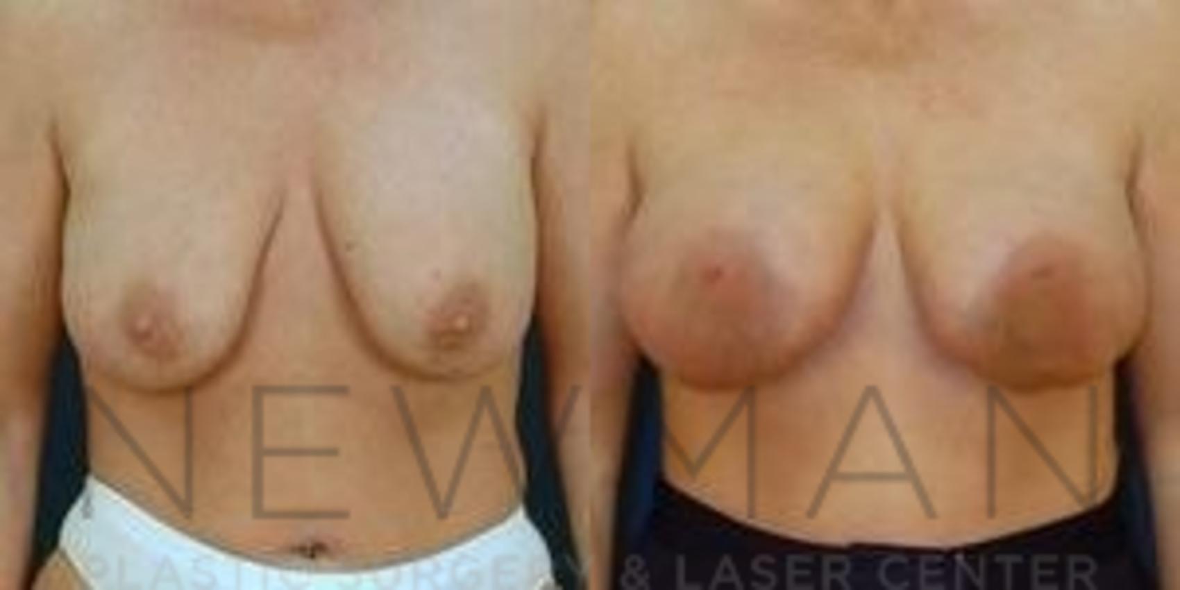 Before & After Breast Augmentation Case 120 Front View in Westchester County & Long Island, NY