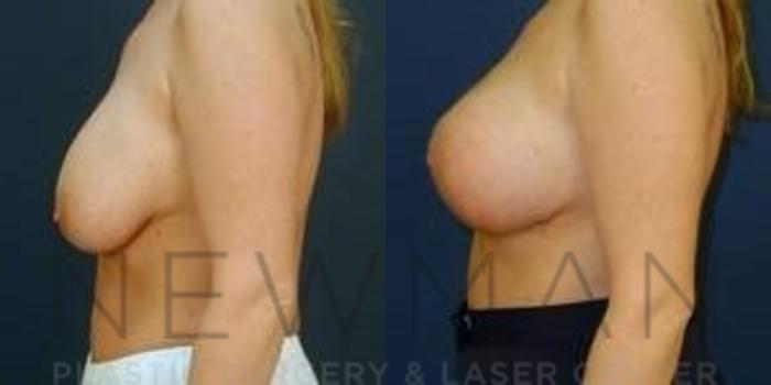 Before & After Breast Augmentation Case 120 Left Side View in Westchester County & Long Island, NY