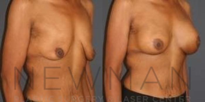 Before & After Breast Augmentation Case 121 Right Oblique View in Westchester County & Long Island, NY