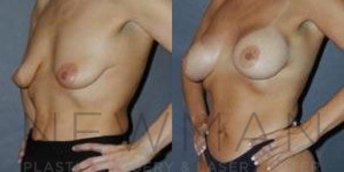 Before & After Breast Augmentation Case 122 Left Oblique View in Westchester County & Long Island, NY