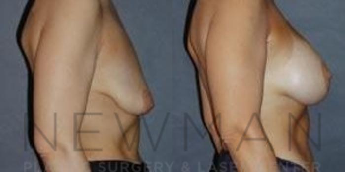 Before & After Breast Augmentation Case 122 Right Side View in Westchester County & Long Island, NY