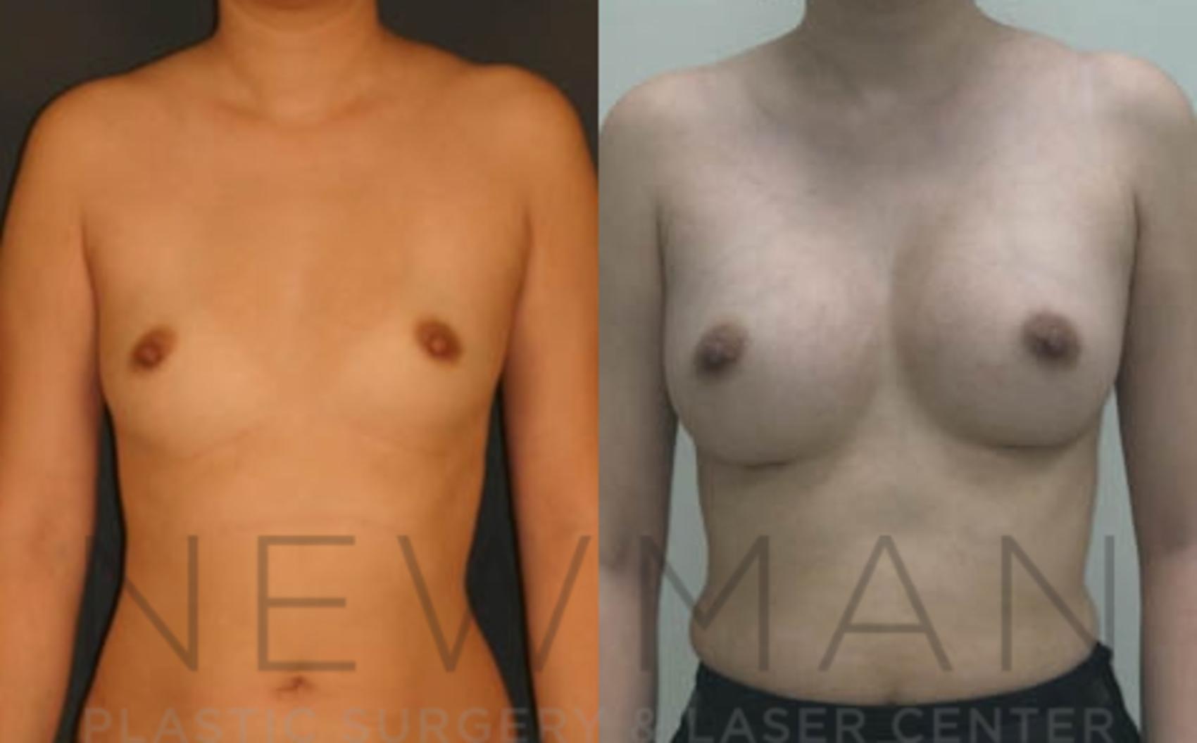 Before & After Breast Augmentation Case 13 Front View in Westchester County & Long Island, NY