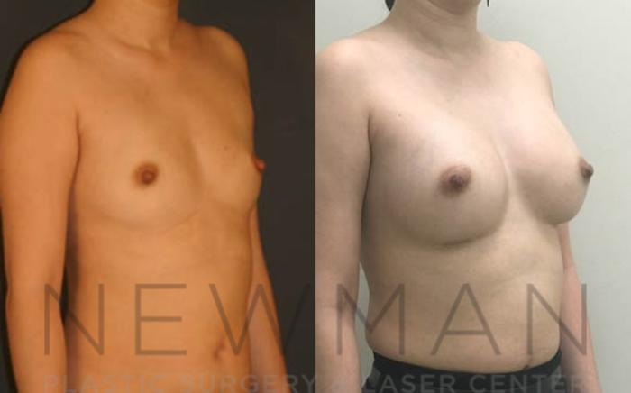 Before & After Breast Augmentation Case 13 Right Oblique View in Westchester County & Long Island, NY