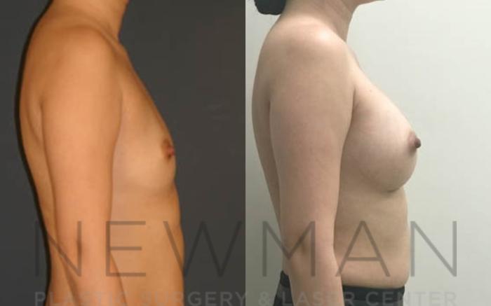 Before & After Breast Augmentation Case 13 Right Side View in Westchester County & Long Island, NY
