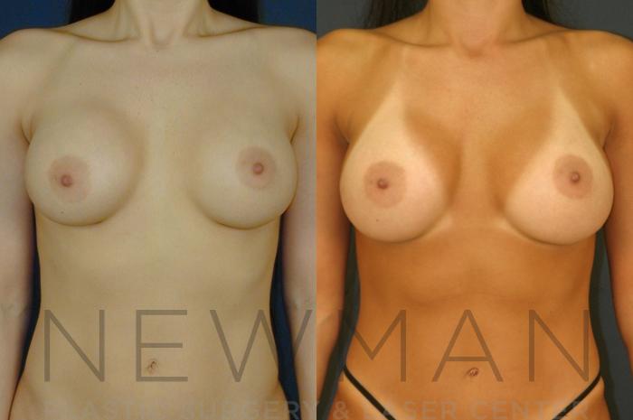 Before & After Breast Augmentation Case 133 Front View in Westchester County & Long Island, NY