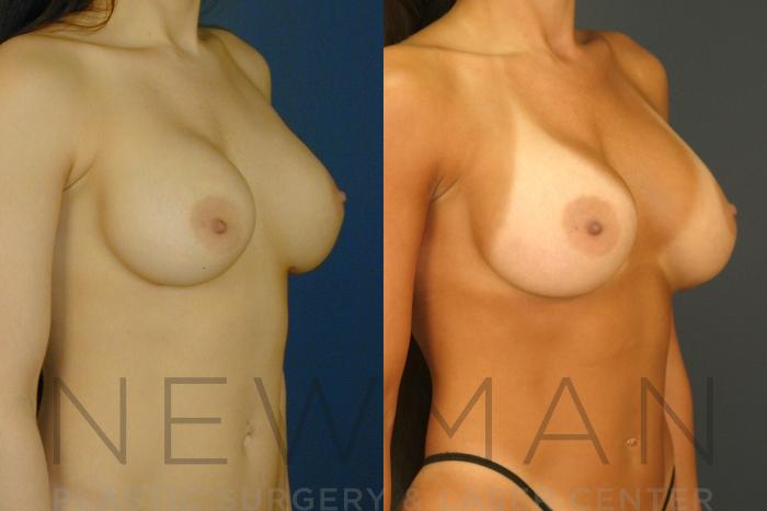 Before & After Breast Implants Case 133 Right Oblique View in Westchester County & Long Island, NY