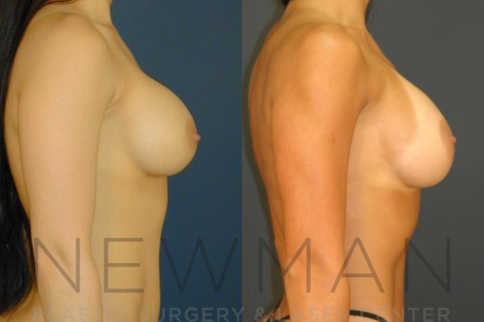 Before & After Breast Asymmetry Case 133 Right Side View in Westchester County & Long Island, NY