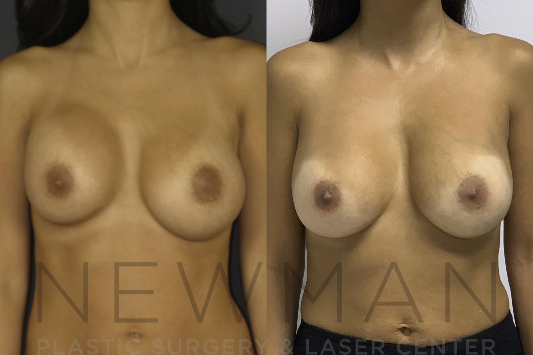 Before & After Breast Augmentation Case 134 Front View in Yonkers, NY