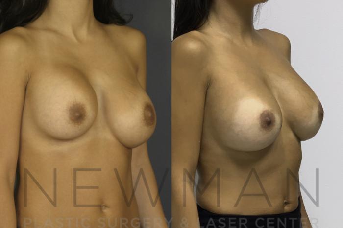 Before & After Breast Asymmetry Case 134 Right Oblique View in Westchester County & Long Island, NY