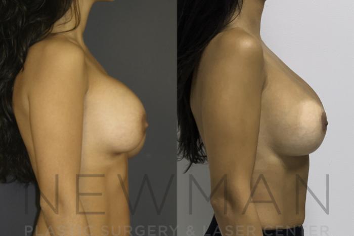 Before & After Breast Augmentation Case 134 Right Side View in Westchester County & Long Island, NY