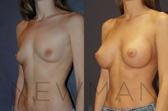 Before & After Breast Augmentation Case 14 Left Oblique View in Westchester County & Long Island, NY