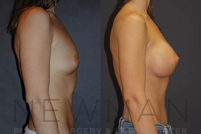 Before & After Breast Augmentation Case 14 Right Side View in Westchester County & Long Island, NY
