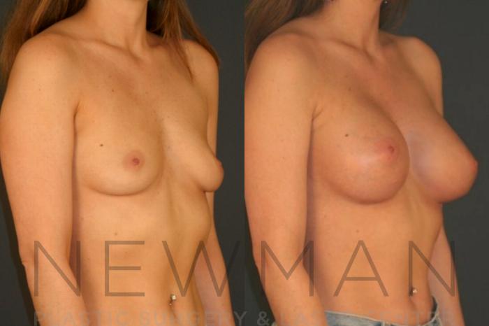 Before & After Breast Augmentation Case 15 Right Oblique View in Westchester County & Long Island, NY