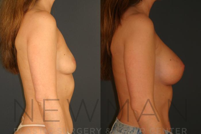 Before & After Breast Augmentation Case 15 Right Side View in Westchester County & Long Island, NY