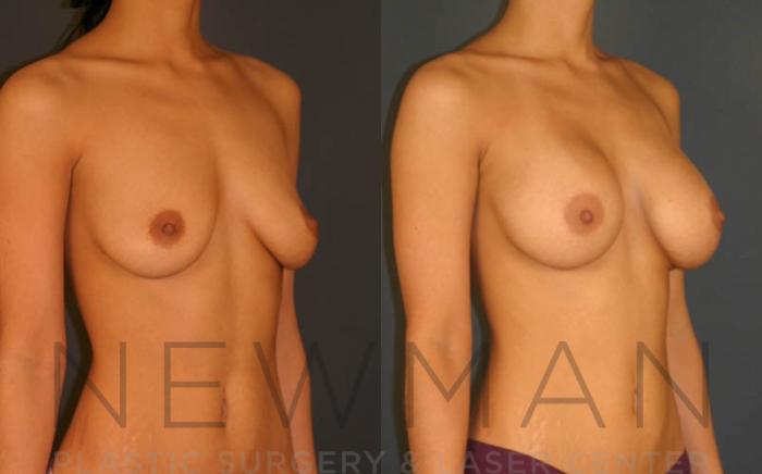 Before & After Breast Augmentation Case 16 Right Oblique View in Westchester County & Long Island, NY