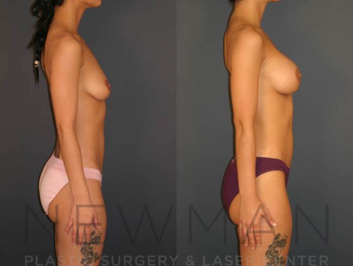 Before & After Breast Augmentation Case 16 Right Side View in Westchester County & Long Island, NY