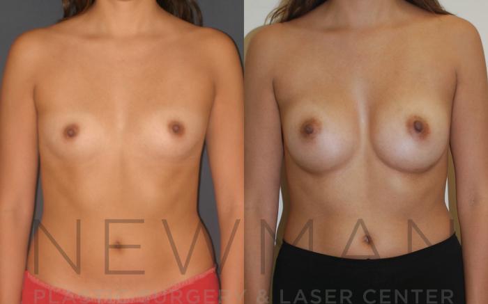 Before & After Breast Augmentation Case 17 Front View in Westchester County & Long Island, NY