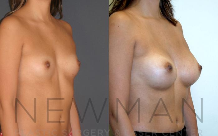 Before & After Breast Augmentation Case 17 Right Oblique View in Westchester County & Long Island, NY