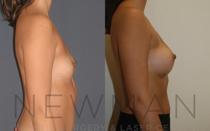 Before & After Breast Augmentation Case 17 Right Side View in Westchester County & Long Island, NY