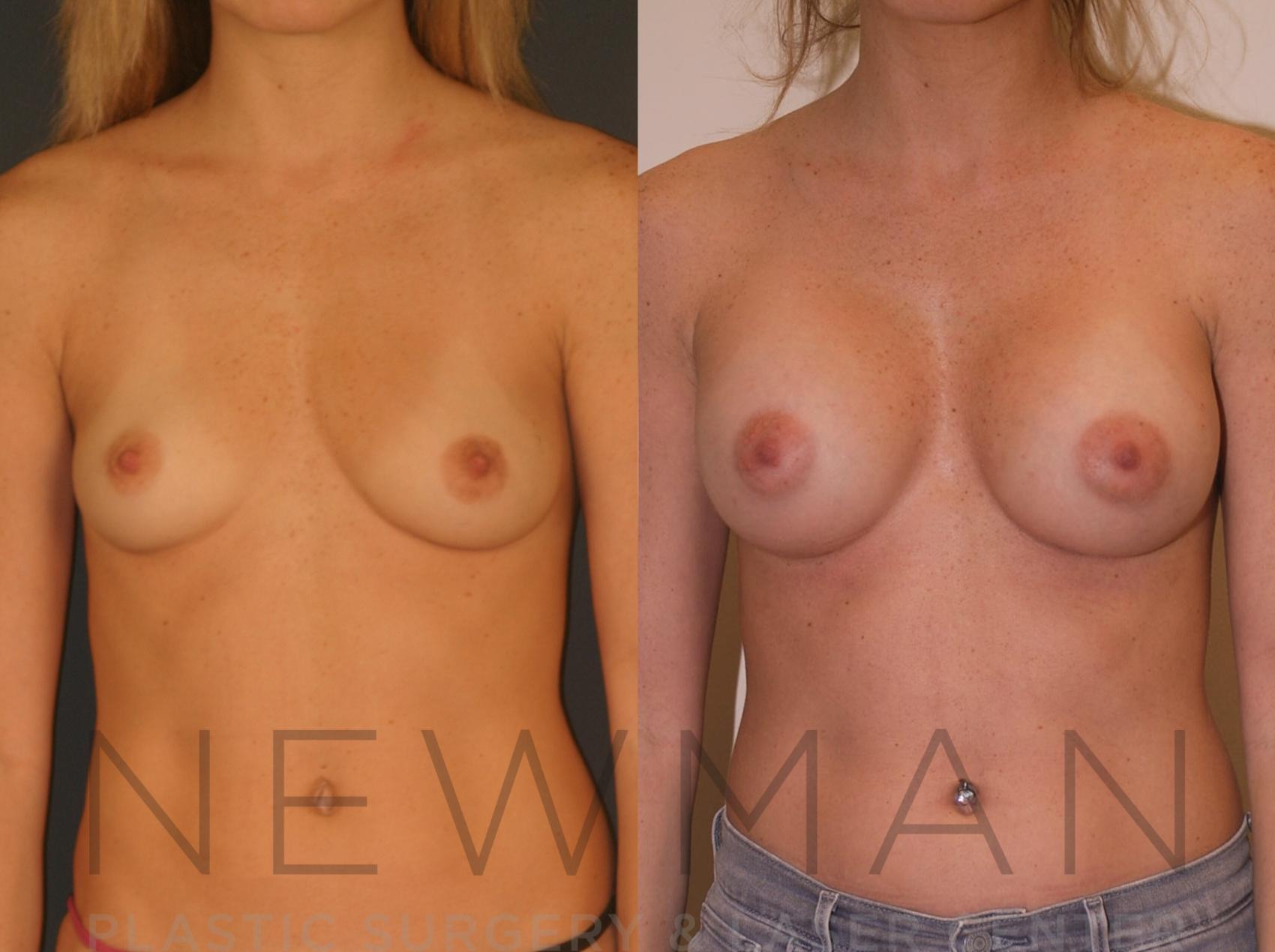 Before & After Breast Augmentation Case 18 Front View in Westchester County & Long Island, NY