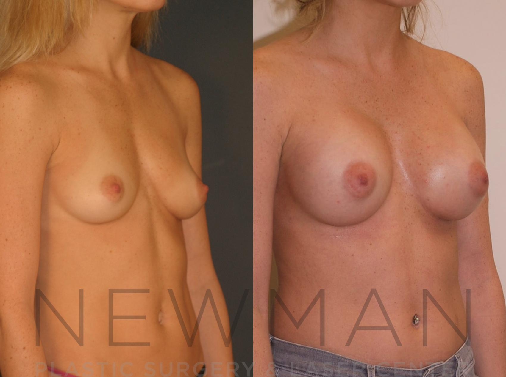 Before & After Breast Augmentation Case 18 Right Oblique View in Westchester County & Long Island, NY