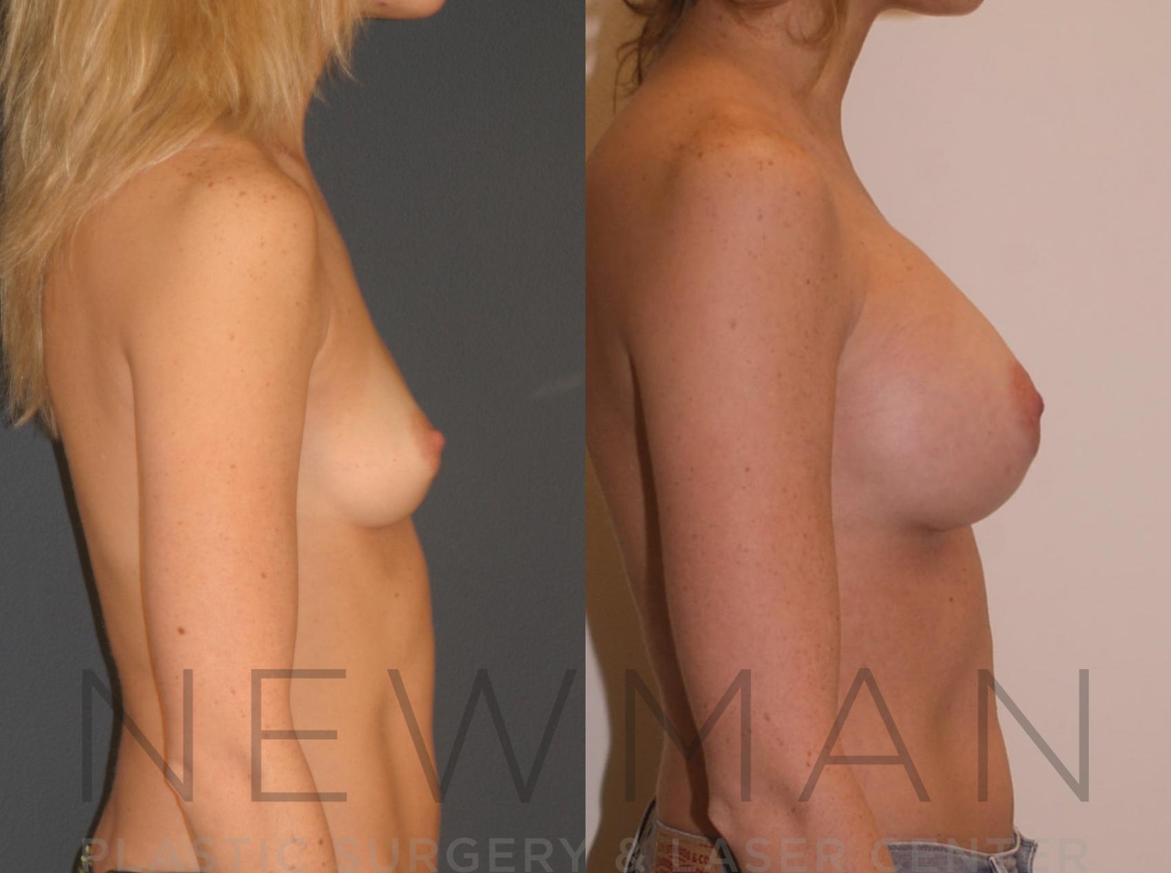 Before & After Breast Augmentation Case 18 Right Side View in Westchester County & Long Island, NY