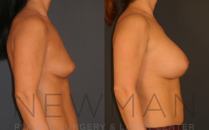 Before & After Breast Augmentation Case 19 Right Side View in Westchester County & Long Island, NY