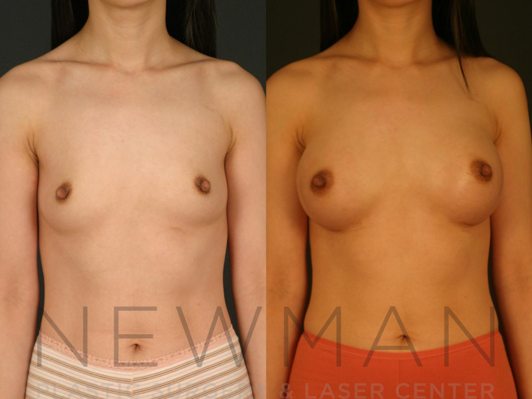 Before & After Breast Augmentation Case 20 Front View in Yonkers, NY