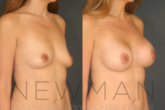 Before & After Breast Augmentation Case 21 Right Oblique View in Westchester County & Long Island, NY